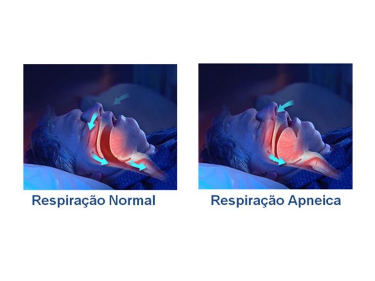 SÍNDROME DA APNÉIA OBSTRUTIVA DO SONO